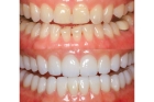 Частичная реставрация зуба