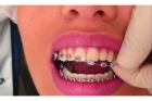 Снятие брекет-системы (с одного зубного ряда)