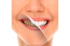 Ультразвуковое удаление над- и поддесневых отложений с зубов