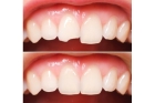Эстетическая реставрация  коронки зуба с помощью светоотверждаемых материалов 