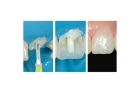 Эстетическая реставрация  коронки зуба с применением стекловолоконного штифта и светоотверждаемых материалов 