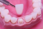 Восстановление зуба металлокерамической коронкой