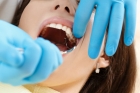 Стандартное удаление зуба