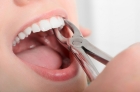 Удаление коренного зуба