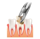 Удаление нижних зубов