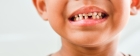 Лечение гипоплазии зубов у детей