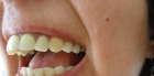 Коронка на часть зуба