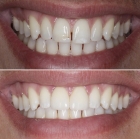 Художественная реставрация фронтальной группы зубов композитным материалом