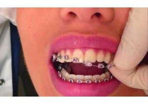 Снятие брекет-системы (с одного зубного ряда)