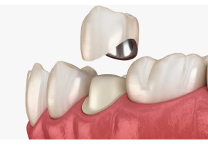 Восстановление зуба коронкой постоянной металлокерамической