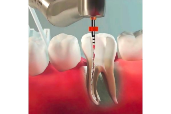 Лечение пульпита 2-х канального зуба