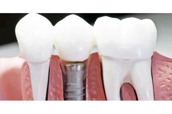 Протезирование зуба с использованием оттискного трансфера, аналога импланта на индивидуальном и стандартном абатменте